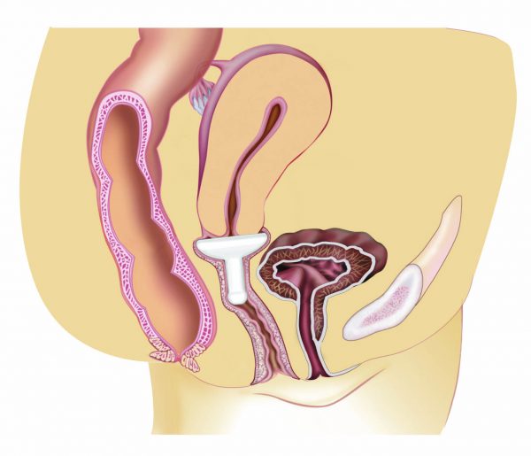 Gellhorn pessary inserted